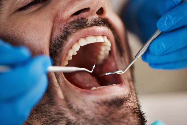 Best Emergency Dental Care for Broken or Chipped Teeth in Lutcher, LA
