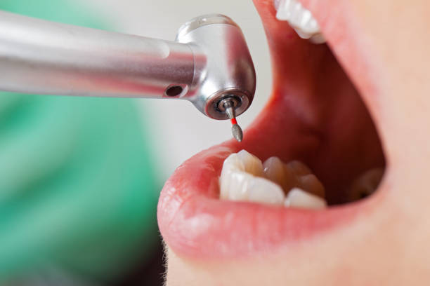 Best Emergency Dental Care for Broken or Chipped Teeth in Lutcher, LA